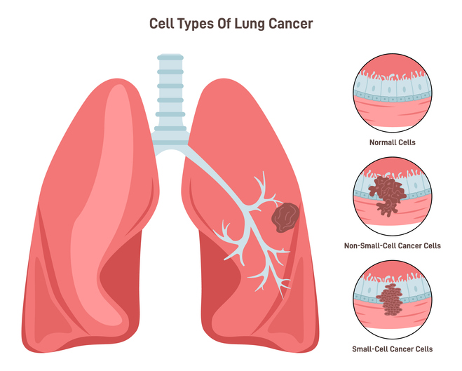 Cancer du poumon, représentation des cellules normales et des cellules cancérigènes